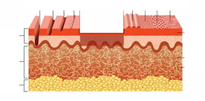 types of laser peeling